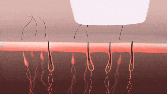兩種脫毛儀-808orOPT，你會如何選