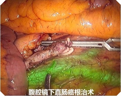 腹腔鏡下直腸癌熒光效果 腹腔鏡下直腸癌熒光效果